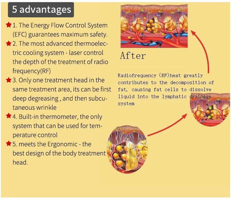 2023 New Popular Exilis Elite Rf Body Tightening Machine Face Lifting Ultra 360 Femme Machine For Beauty Salon Use