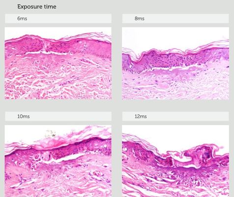 Chinese Famous Manufacture Fractional RF Microneedling Machine Fractional Microneedle