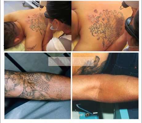 Hot sale Portable nd yag laser tattoo removal equipment body tattoo removal ND YAG laser